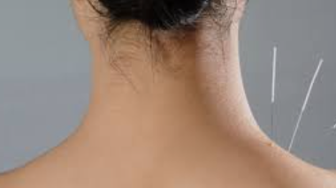 Acupuntura