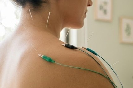 Mostrar un tratamiento con electroacupuntura